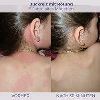 Rötung und Reizung auf Kinderhaut mit Hydro Lotion behandelt