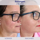 Vorher-Nachher Hautrötungsbehandlung mit Hydro Lotion für klare Haut