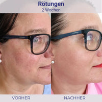 Vorher-Nachher Hautrötungsbehandlung mit Hydro Lotion für klare Haut