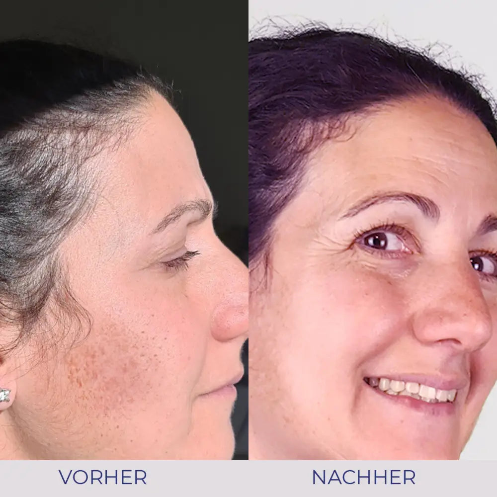 Vorher-Nachher Hautbehandlung mit Intensive Cream für glattere Haut