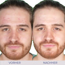 Vorher-Nachher-Bild der Aknebehandlung mit Intensive Cream für glatte Haut