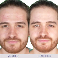 Vorher-Nachher-Bild der Aknebehandlung mit Intensive Cream für glatte Haut