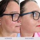 Vorher-Nachher Hautbehandlung Vergleich mit Intensive Cream, für strahlende Haut