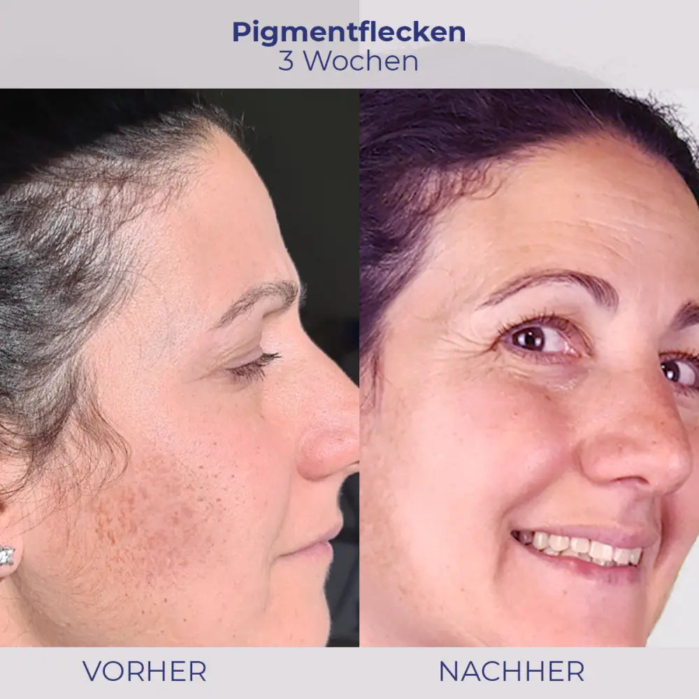 Vorher-Nachher Hautpigmentationsbehandlung mit NOVIGEL von klinischem Ergebnis