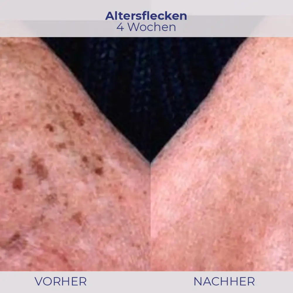 Alterflecken Behandlung Vergleich mit NOVIGEL für jüngeres Hautbild