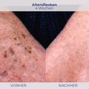 Alterflecken Behandlung Vergleich mit NOVIGEL für jüngeres Hautbild