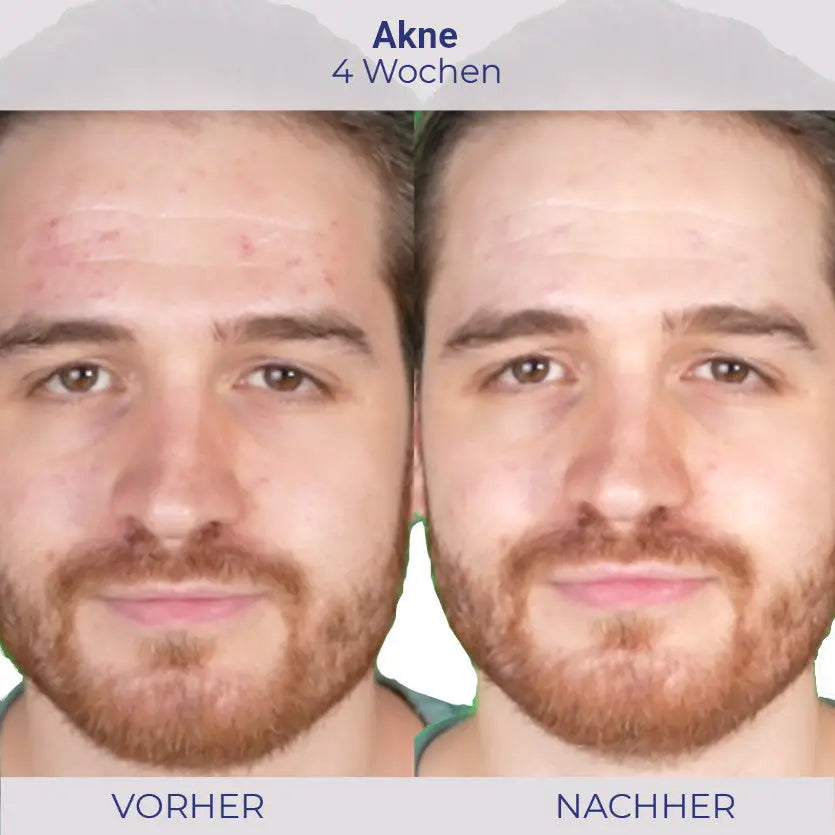 Acne Behandlung Vorher Nachher mit NOVIGEL für klarere Haut